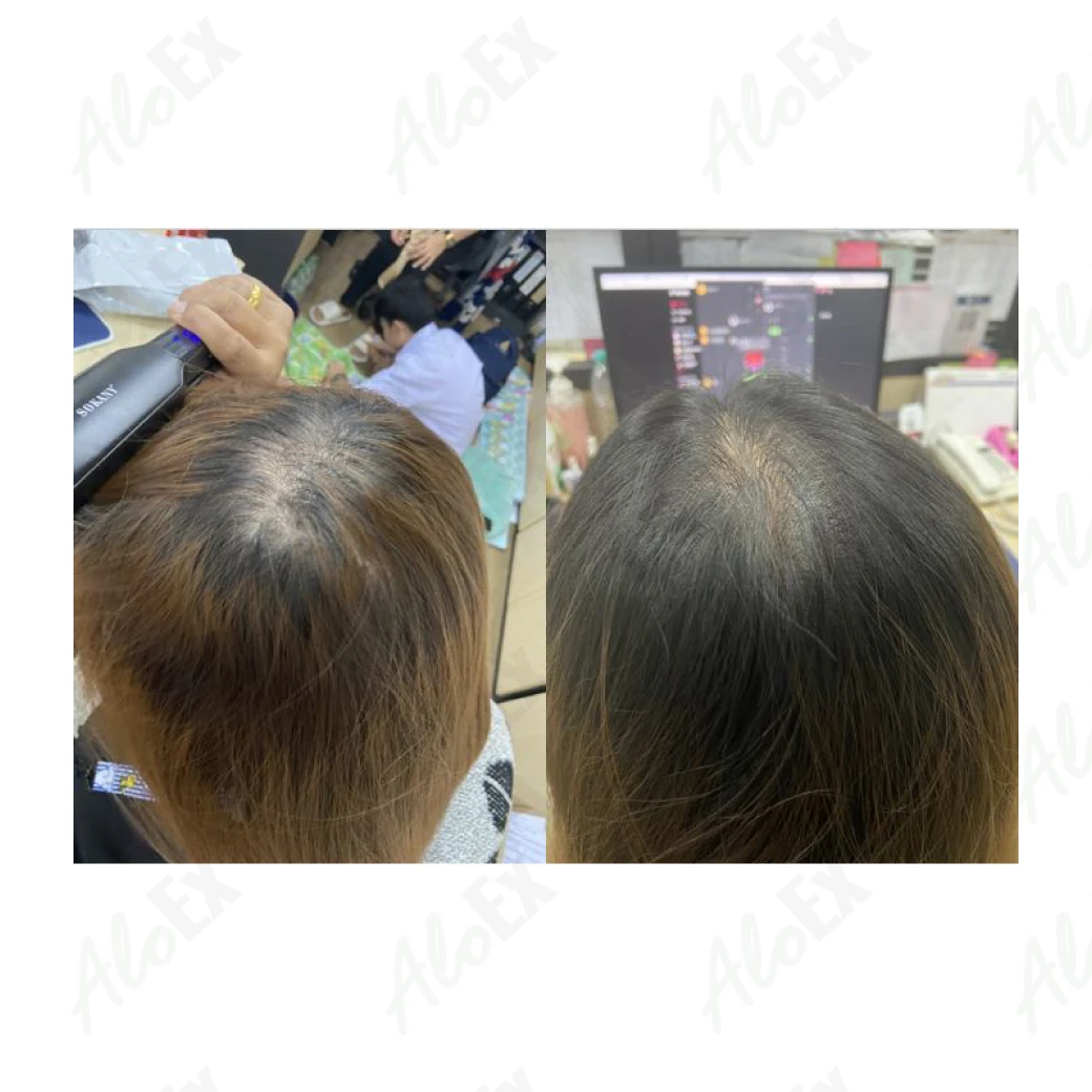 รีวิวก่อนใช้-หลังใช้ ผลิตภัณฑ์ AloEx