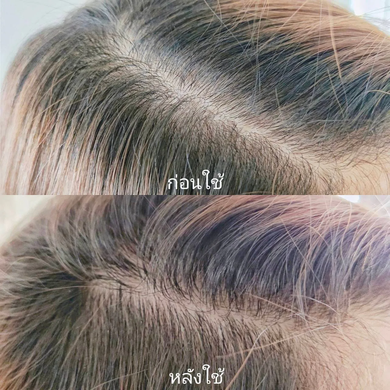 เซรั่มของ AloEx ตัวนี้คือช่วยลดอาการผมร่วงได้ดีมาก