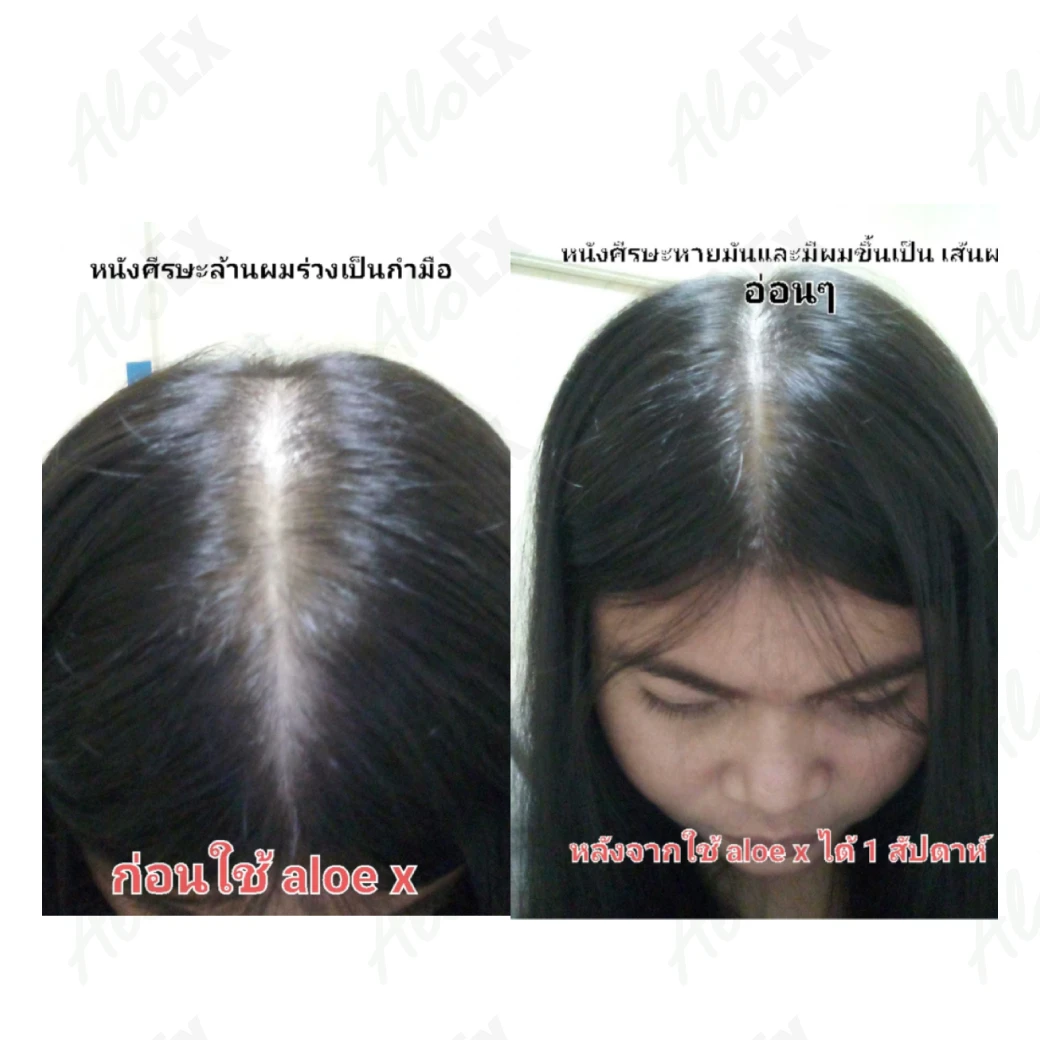 หนังศีรษะหายมันและมีเส้นผมขึ้นเป็น เส้นอ่อนๆ