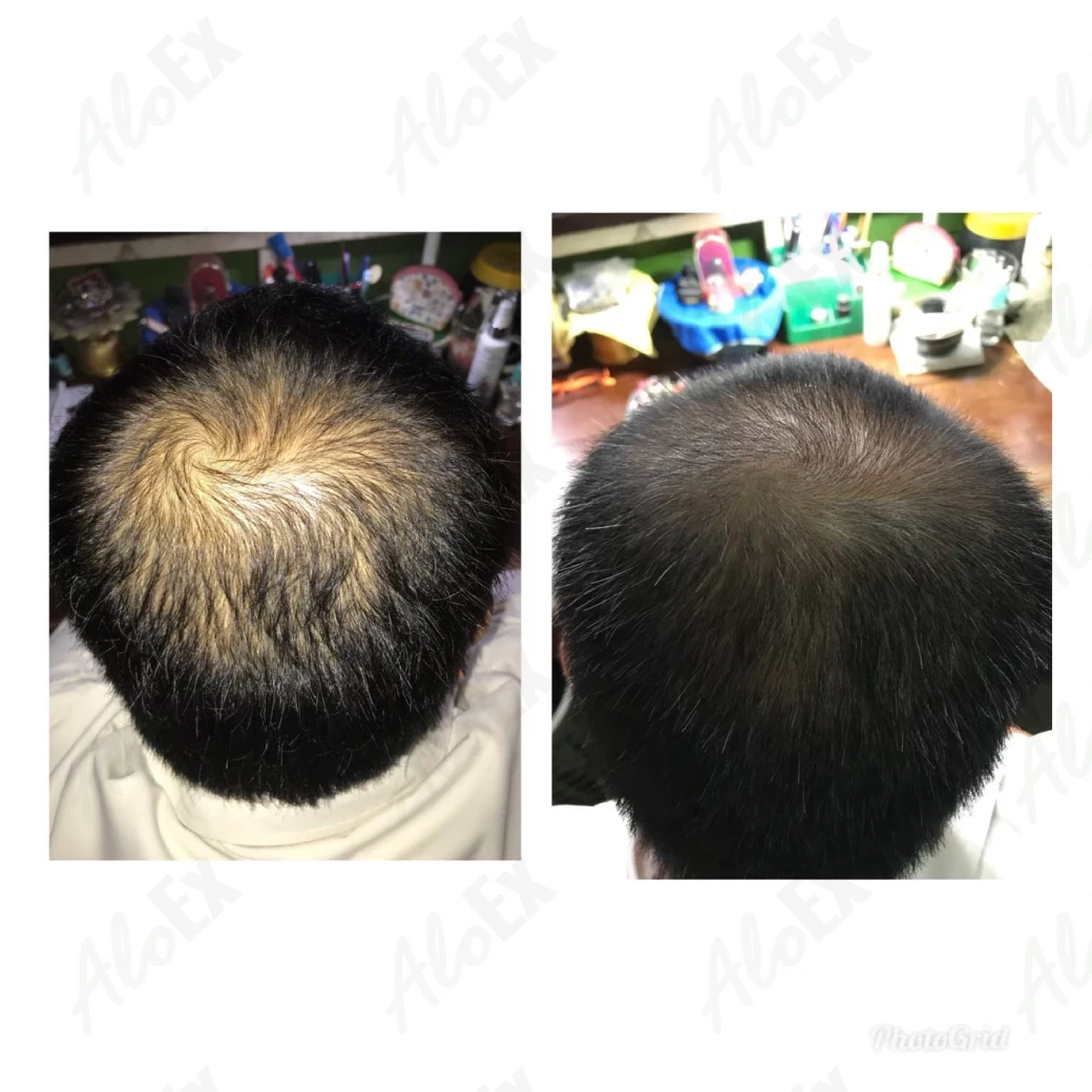 รีวิวก่อนใช้-หลังใช้ ผลิตภัณฑ์ AloEx