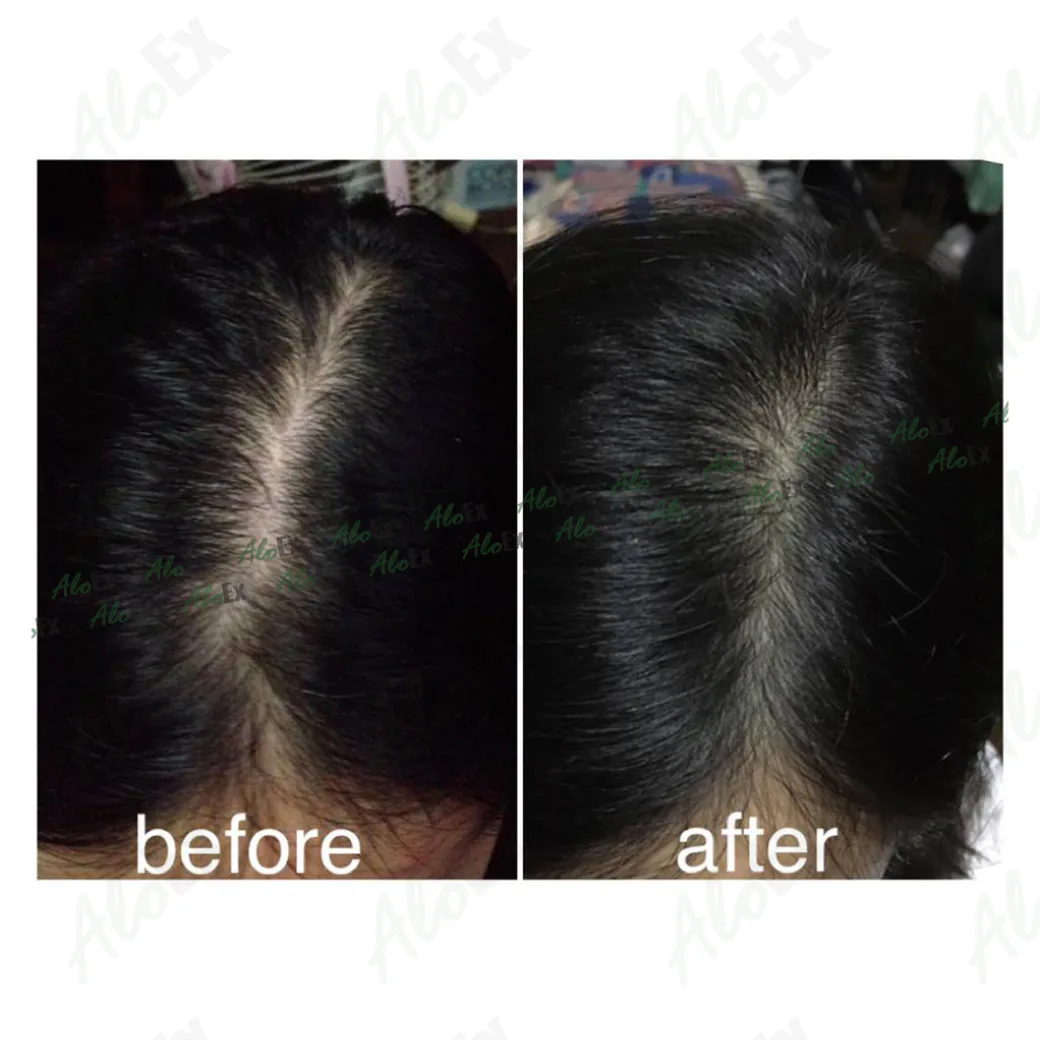 รีวิวก่อนใช้-หลังใช้ ผลิตภัณฑ์ AloEx